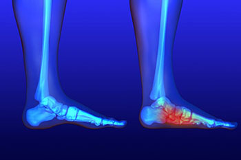 Flat feet treatment in the Norfolk County, MA: Milton (Quincy, Brookline, Weymouth, Braintree, Needham, Norwood, Wellesley, Stoughton, Dedham) areas