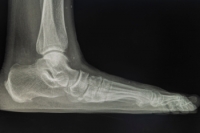 Understanding the Biomechanics of Flat Feet