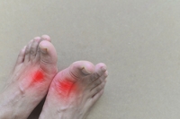 How to Know if You Have Gout