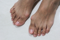 Types and Risks of Bunion Surgery