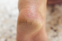 Why Are Cracked Heels More Common in Winter?