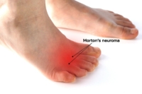 Causes and Symptoms of Morton’s Neuroma